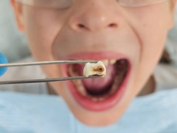 Best Emergency Dental Extractions in Batavia, IL